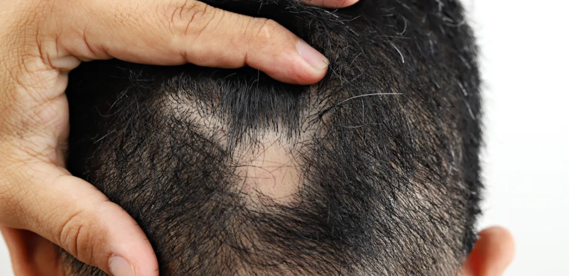 Alopecia-New-and-Existing-Treatments-for-Alopecia.png