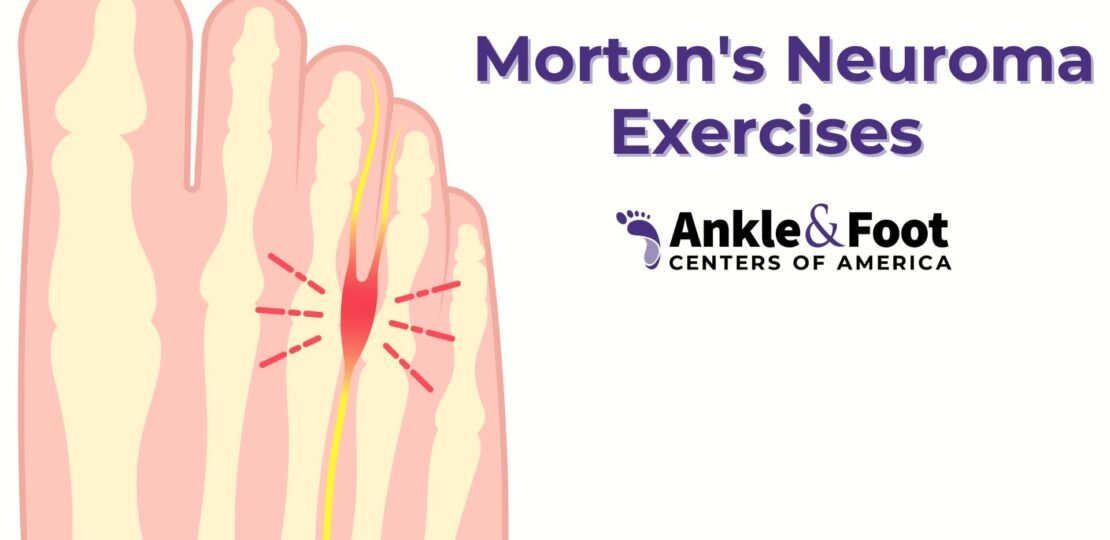 Mortons-Neuroma-Exercises-Say-No-to-Surgery.jpg